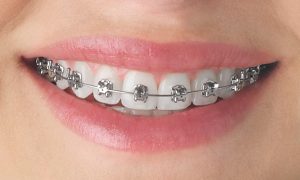 Rögzített fém fogszabályozó készülék közelről — Smile Centrum Miskolc